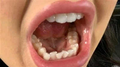 قالت ابنتي ان سنها يؤلمها 